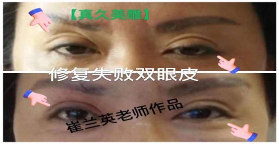 Recovery from Failed Double Eyelid