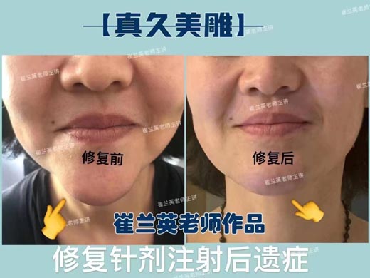Recovery from Injection Sequelae with Authentic Cosmetic Acupuncture