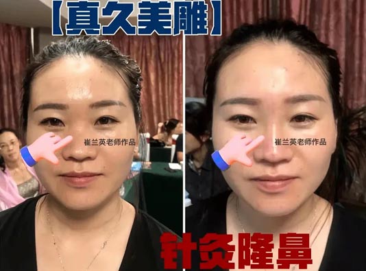 Rhinoplasty with Authentic Cosmetic Acupuncture